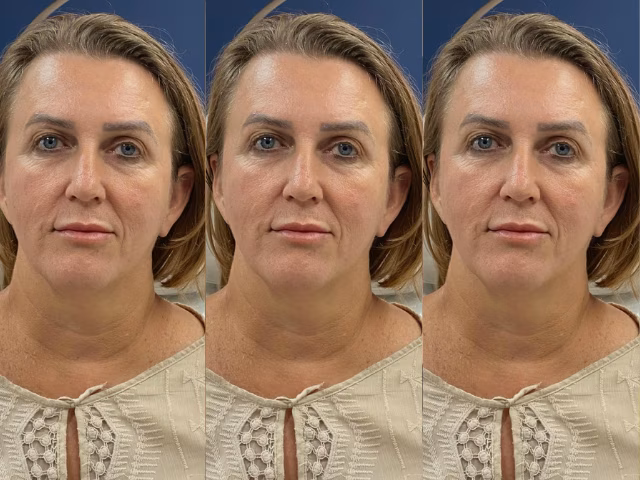 Antes do procedimento Face Full