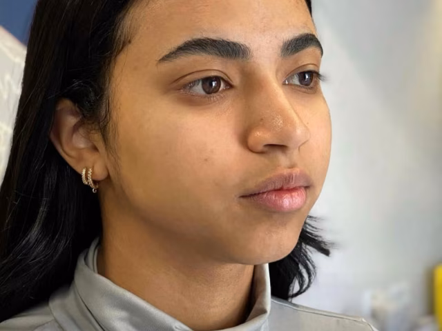 Antes do procedimento Perfil: mento, nariz e boca