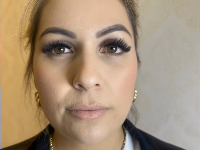 Antes do procedimento Preenchimento Labial