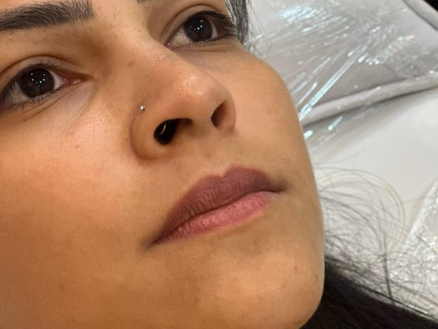 Antes do procedimento Preenchimento de Labial